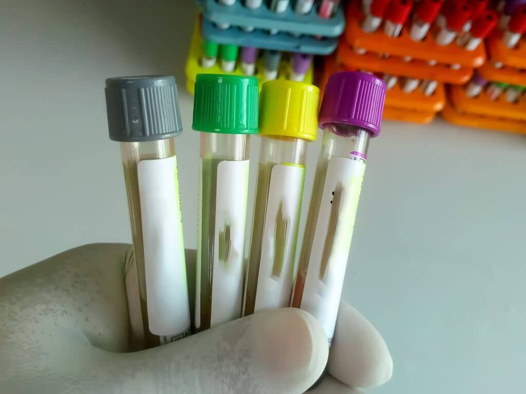 Scientist hold samples transport tube for Sexuallly Transmitted Disease. Syphilis, HBV, HIV, HCV