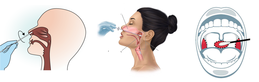 流感咽拭子采樣示意圖