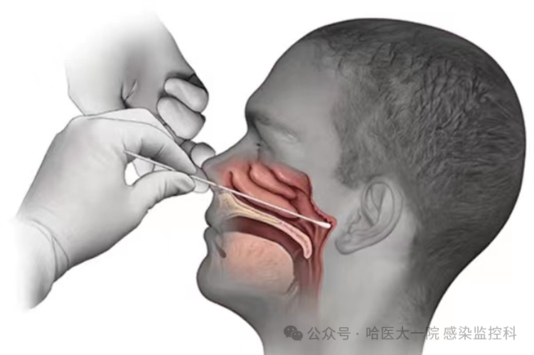 鼻咽拭子的采集示意圖